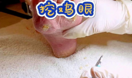 修脚视频,跟随视频学习专业修脚技巧